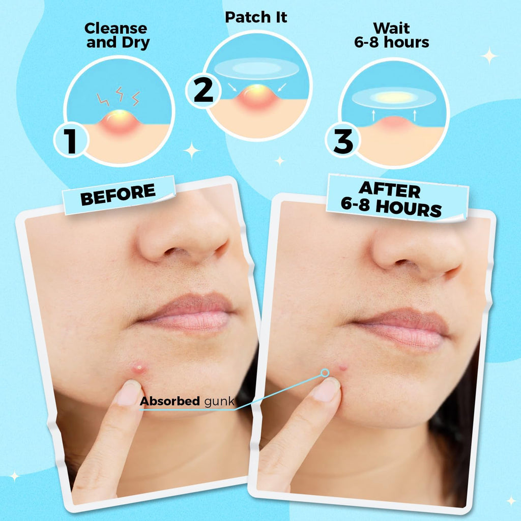 PurePatch Pimple Patches - 96 Hydrocolloid Spot Patches