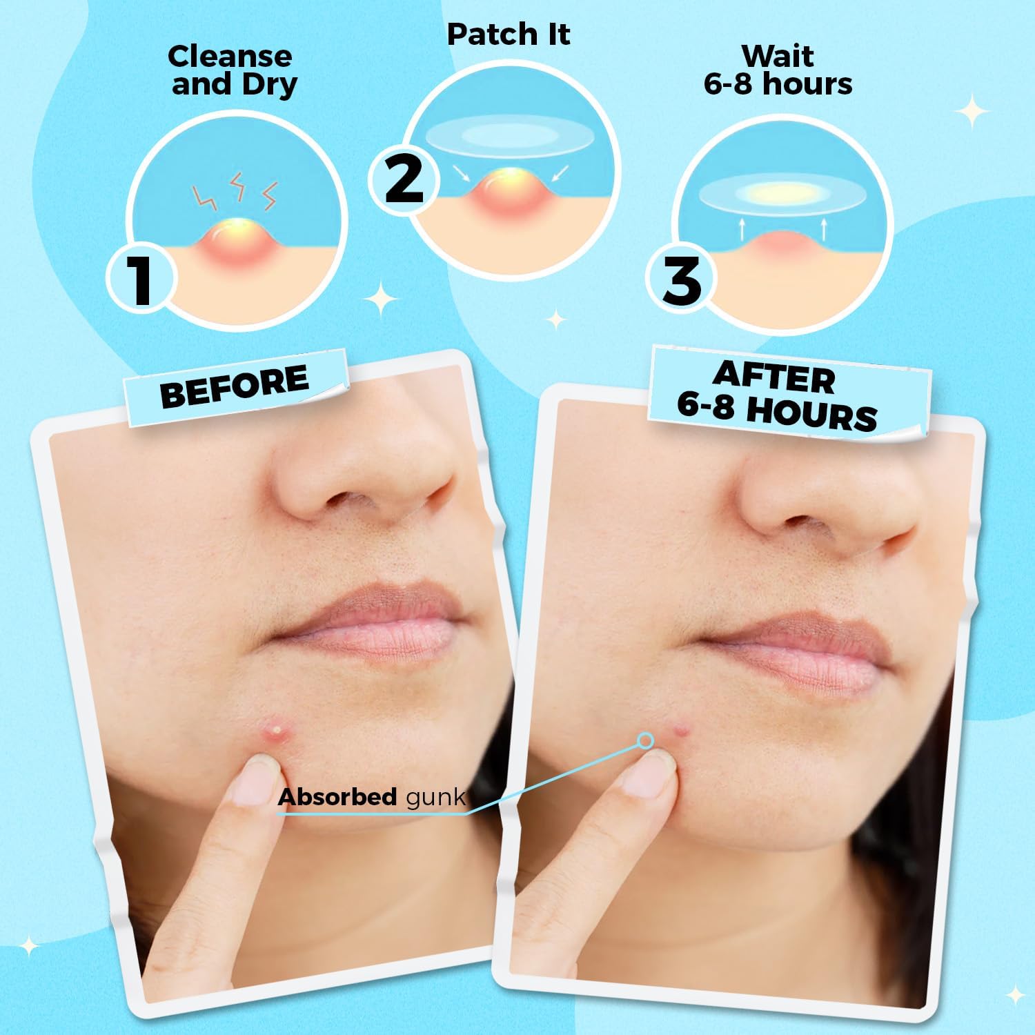 PurePatch Pimple Patches - 96 Hydrocolloid Spot Patches