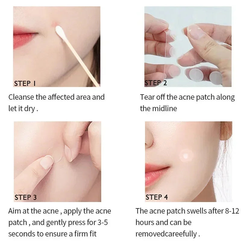 hydrocolloid acne patches